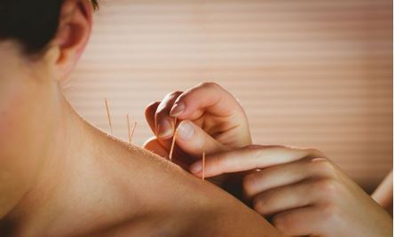 Acupuncture Session