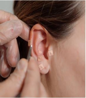 Auricular Therapy 4